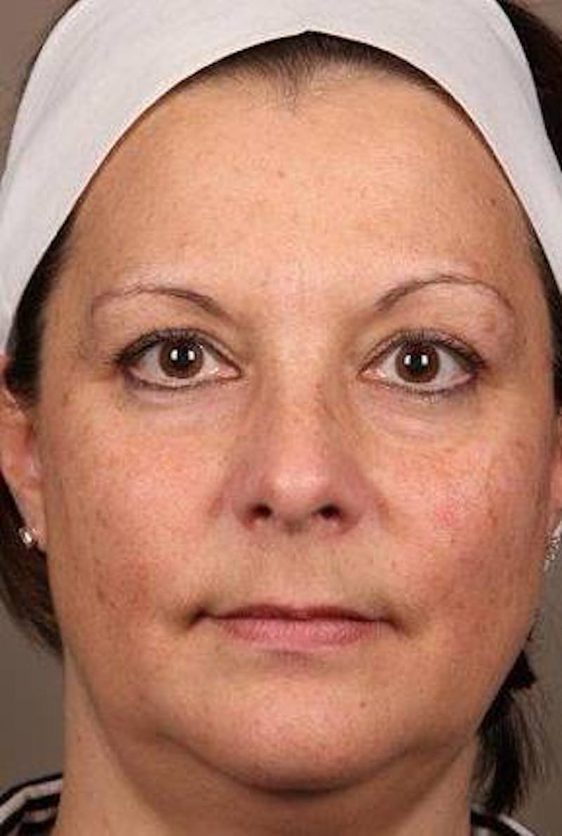 Laser Skin Resurfacing Before & After Gallery - Patient 161983 - Image 2 - Scott Chapin, MD
