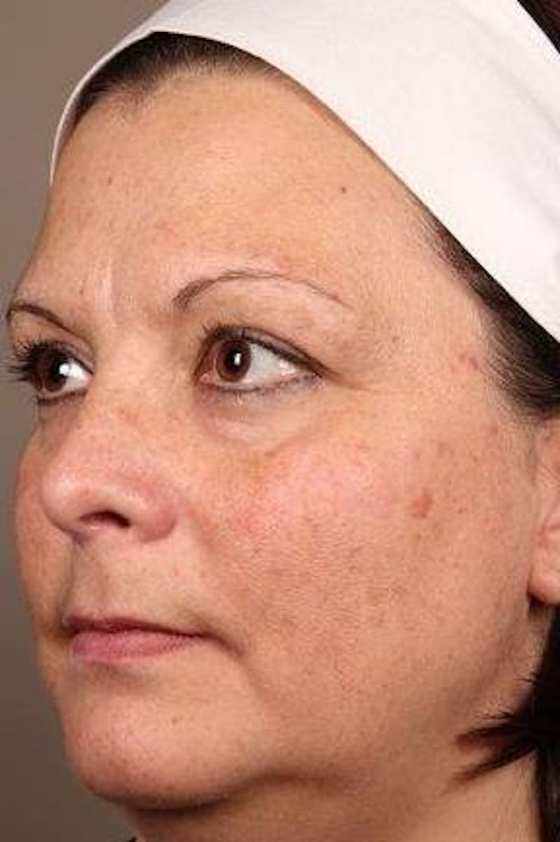 Laser Skin Resurfacing Before & After Gallery - Patient 161983 - Image 3 - Scott Chapin, MD
