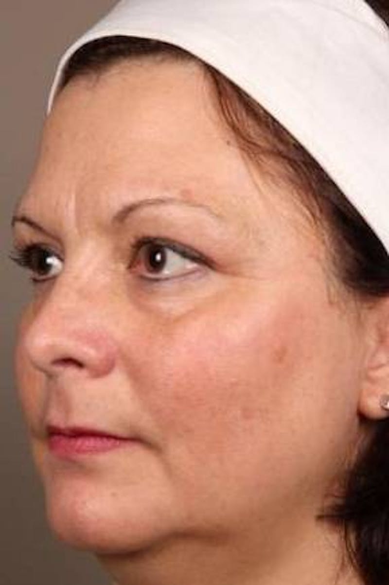 Laser Skin Resurfacing Before & After Gallery - Patient 161983 - Image 4 - Scott Chapin, MD