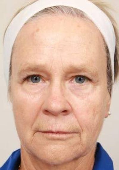 Laser Skin Resurfacing Before & After Gallery - Patient 175478 - Image 1 - Scott Chapin, MD