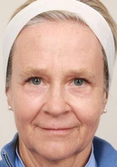 Laser Skin Resurfacing Before & After Gallery - Patient 175478 - Image 2 - Scott Chapin, MD
