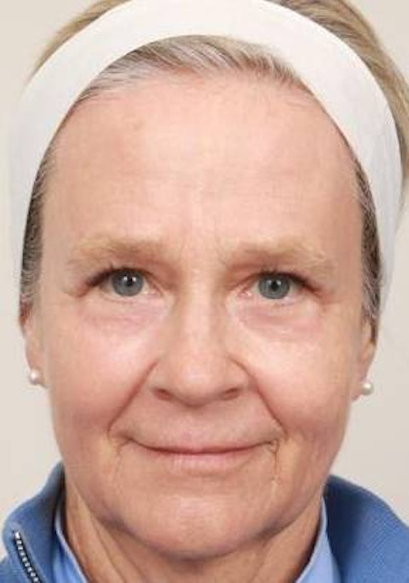 Laser Skin Resurfacing Before & After Gallery - Patient 175478 - Image 2 - Scott Chapin, MD