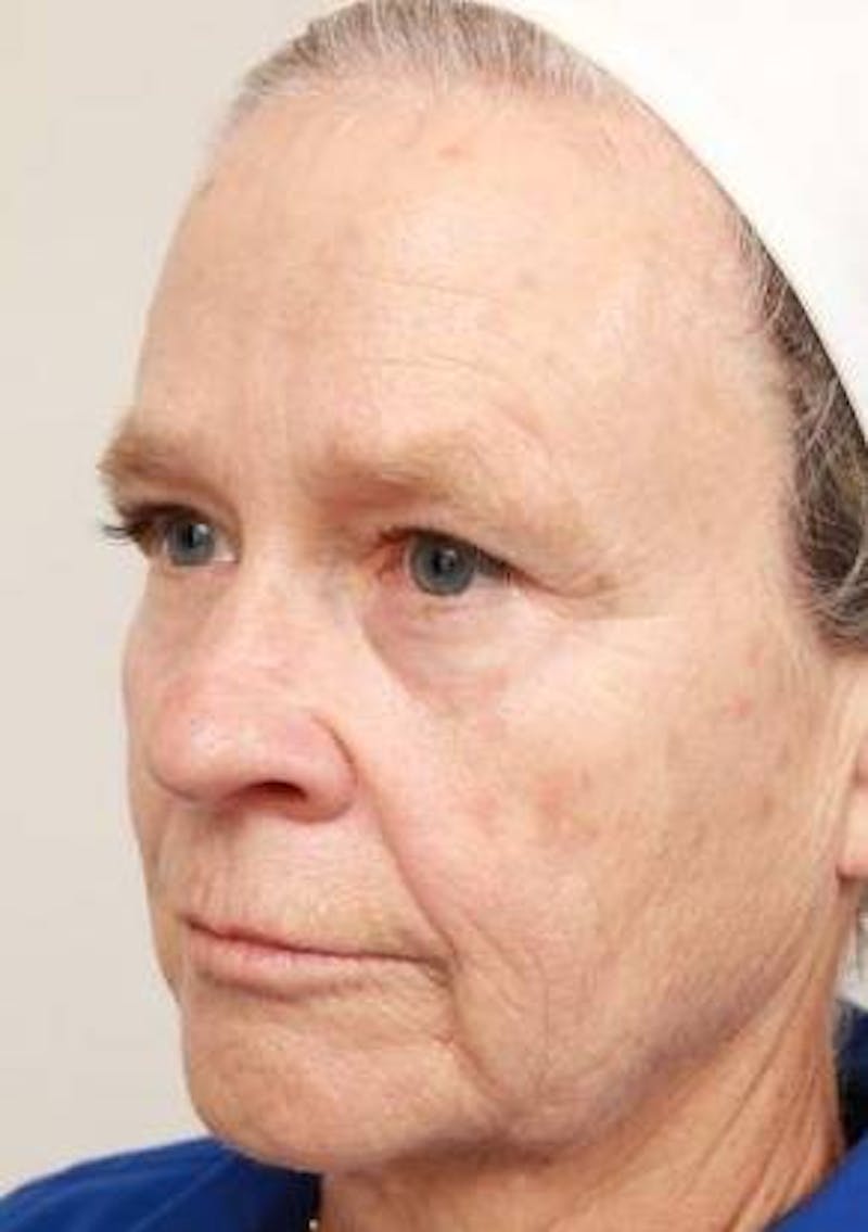Laser Skin Resurfacing Before & After Gallery - Patient 175478 - Image 5 - Scott Chapin, MD