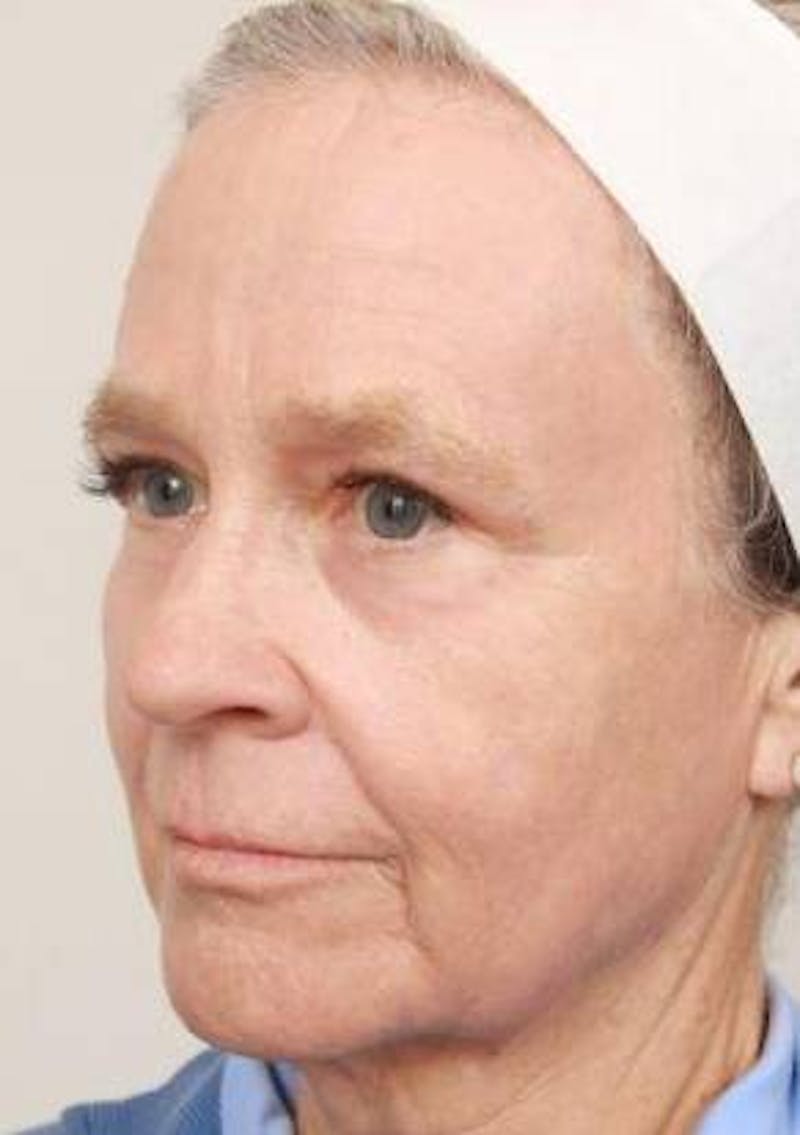 Laser Skin Resurfacing Before & After Gallery - Patient 175478 - Image 6 - Scott Chapin, MD