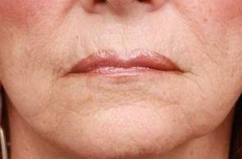 Laser Skin Resurfacing Before & After Gallery - Patient 340520 - Image 1 - Scott Chapin, MD