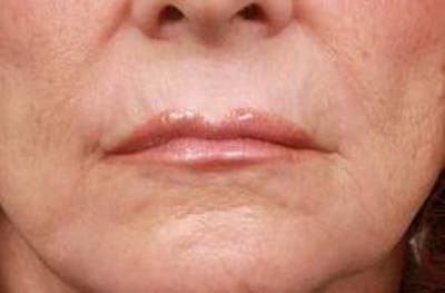 Laser Skin Resurfacing Before & After Gallery - Patient 340520 - Image 2 - Scott Chapin, MD