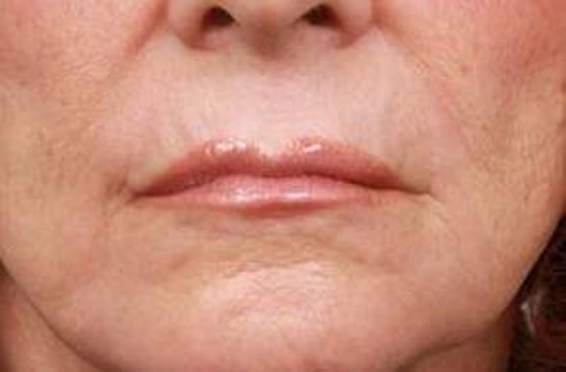 Laser Skin Resurfacing Before & After Gallery - Patient 340520 - Image 2 - Scott Chapin, MD