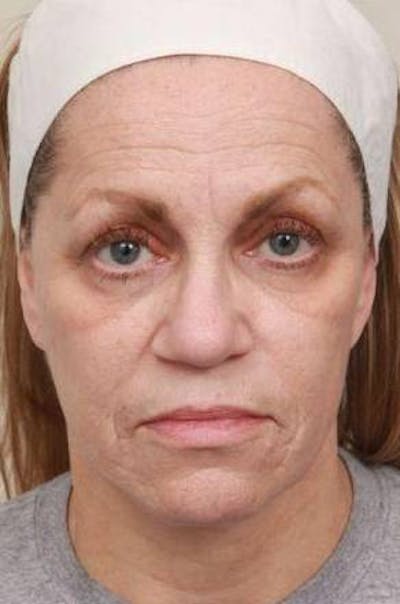 Laser Skin Resurfacing Before & After Gallery - Patient 274889 - Image 1 - Scott Chapin, MD