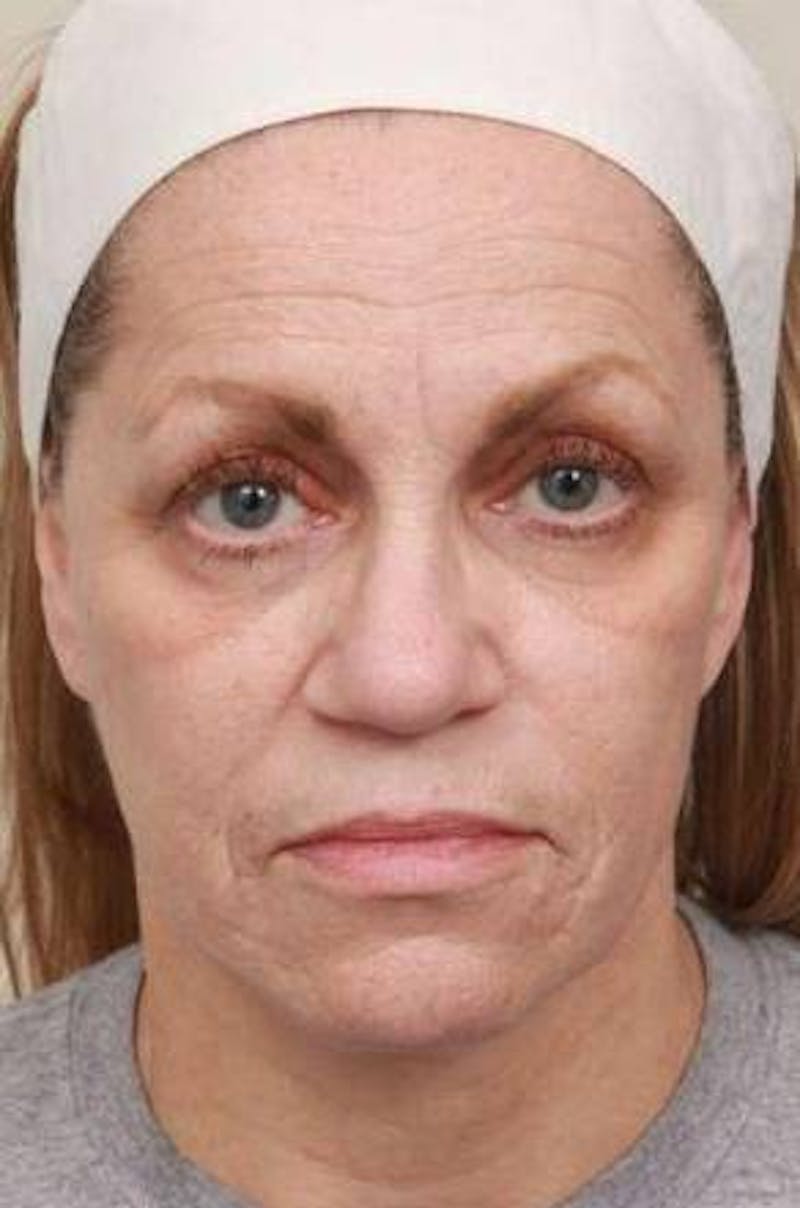 Laser Skin Resurfacing Before & After Gallery - Patient 274889 - Image 1 - Scott Chapin, MD