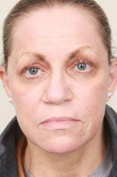 Laser Skin Resurfacing Before & After Gallery - Patient 274889 - Image 2 - Scott Chapin, MD