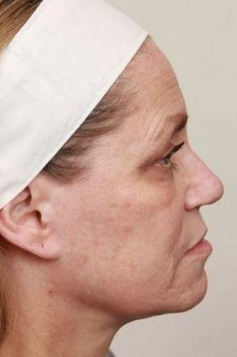 Laser Skin Resurfacing Before & After Gallery - Patient 274889 - Image 3 - Scott Chapin, MD