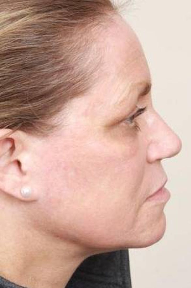 Laser Skin Resurfacing Before & After Gallery - Patient 274889 - Image 4 - Scott Chapin, MD