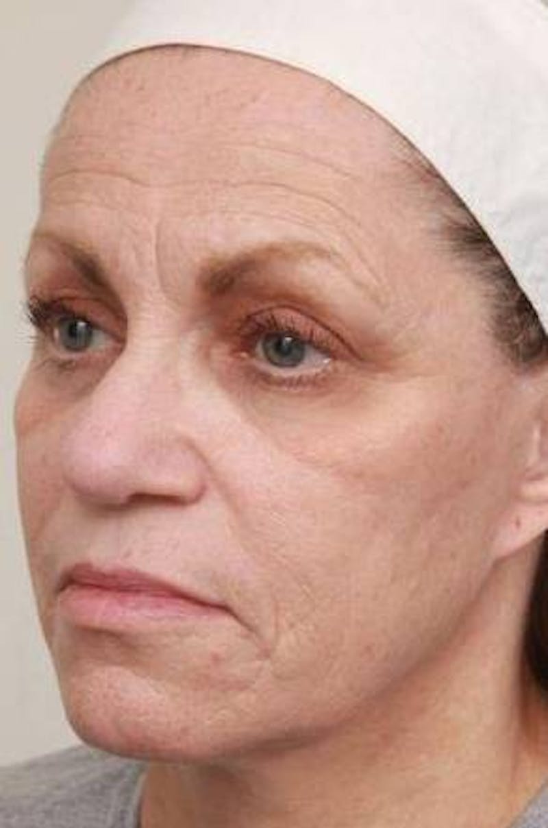 Laser Skin Resurfacing Before & After Gallery - Patient 274889 - Image 5 - Scott Chapin, MD