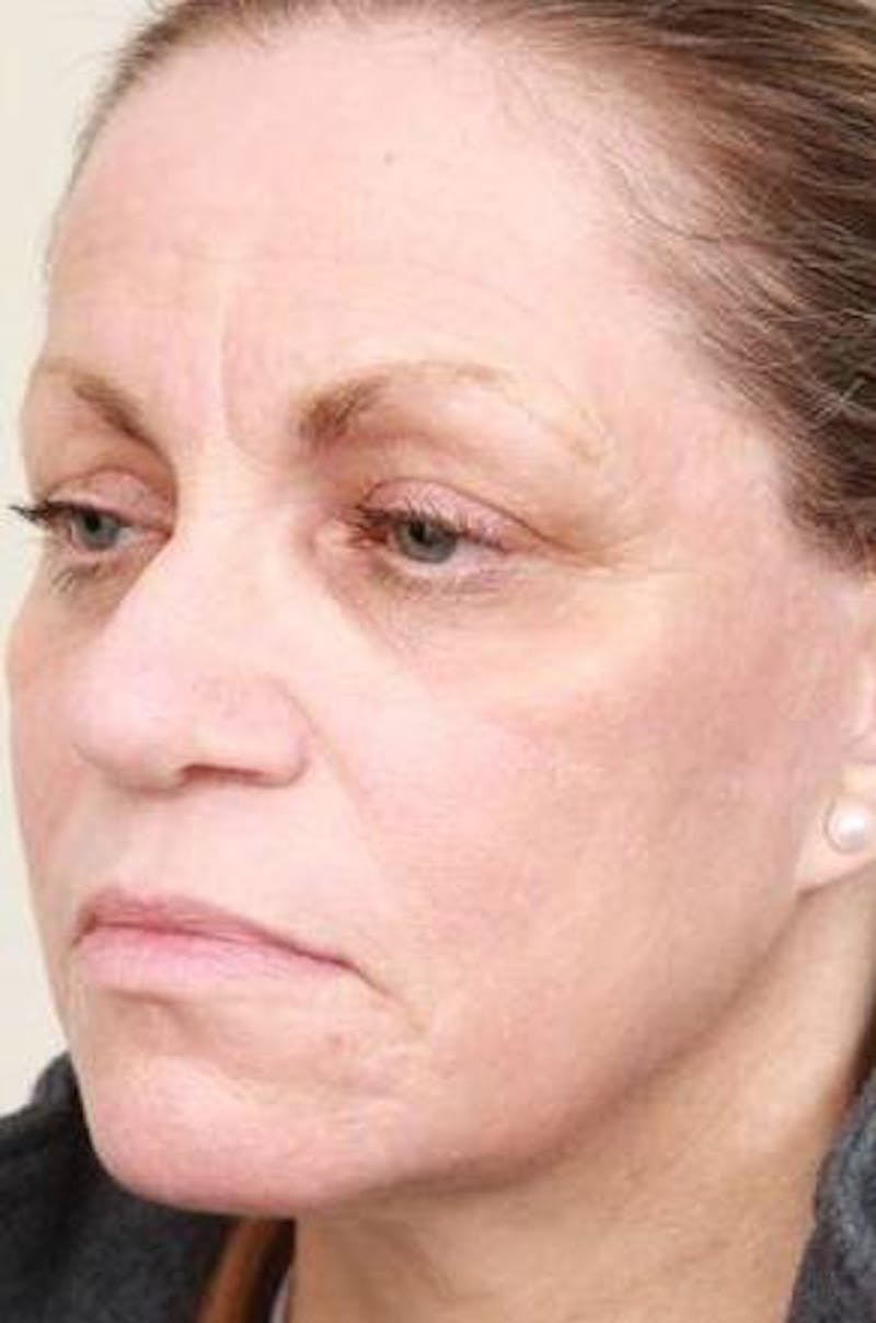 Laser Skin Resurfacing Before & After Gallery - Patient 274889 - Image 6 - Scott Chapin, MD