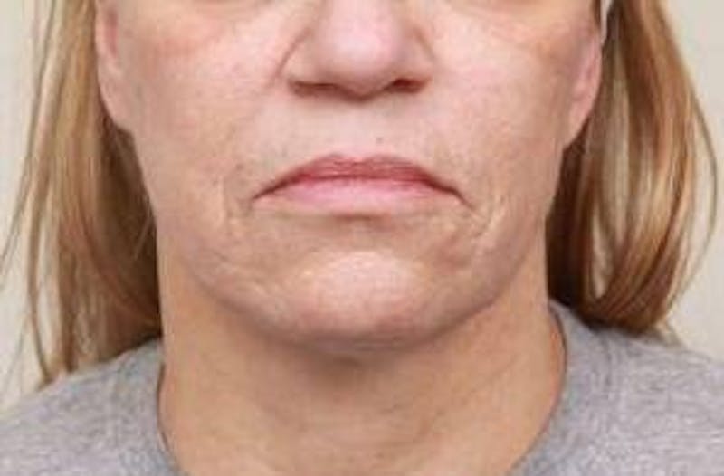 Laser Skin Resurfacing Before & After Gallery - Patient 274889 - Image 7 - Scott Chapin, MD