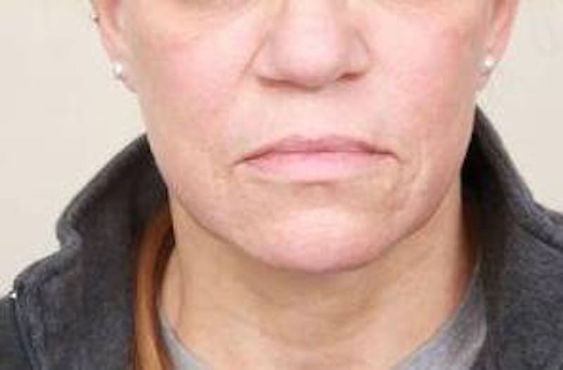 Laser Skin Resurfacing Before & After Gallery - Patient 274889 - Image 8 - Scott Chapin, MD