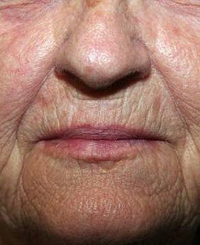 Laser Skin Resurfacing Before & After Gallery - Patient 378278 - Image 1 - Scott Chapin, MD
