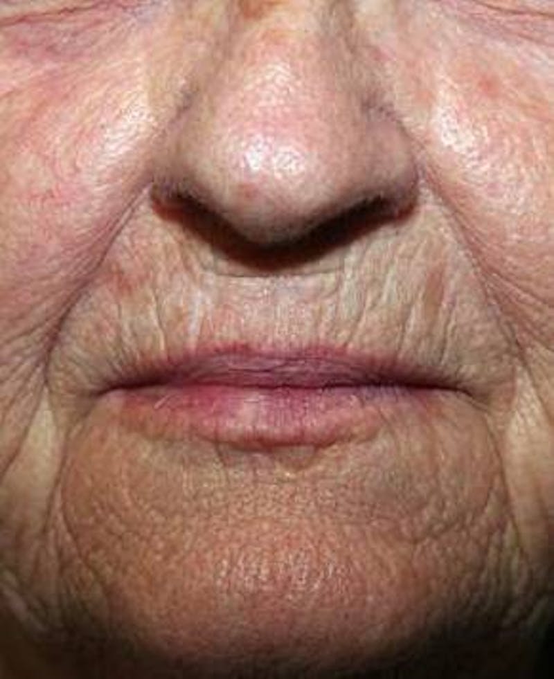 Laser Skin Resurfacing Before & After Gallery - Patient 378278 - Image 1 - Scott Chapin, MD