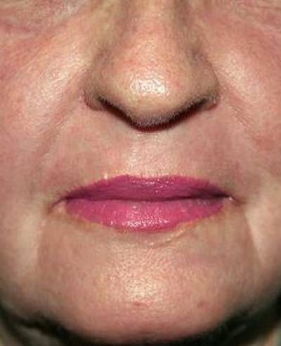 Laser Skin Resurfacing Before & After Gallery - Patient 378278 - Image 2 - Scott Chapin, MD