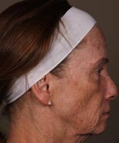 Laser Skin Resurfacing Before & After Gallery - Patient 181898 - Image 1 - Scott Chapin, MD