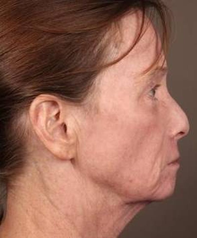 Laser Skin Resurfacing Before & After Gallery - Patient 181898 - Image 2 - Scott Chapin, MD