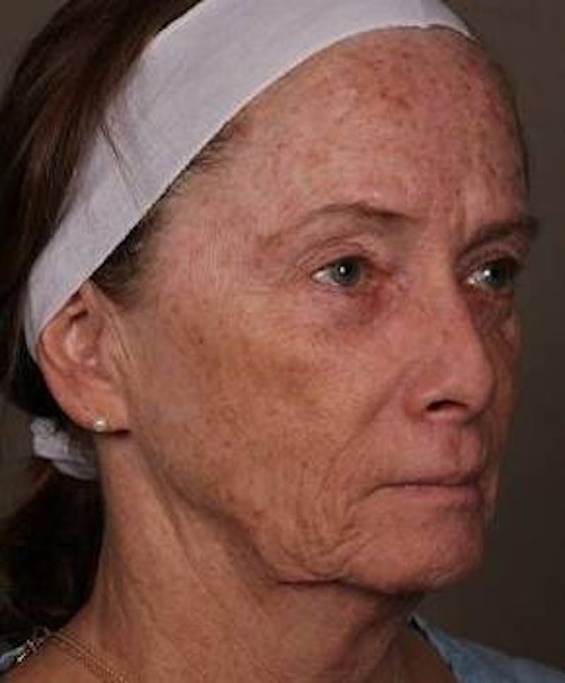Laser Skin Resurfacing Before & After Gallery - Patient 181898 - Image 3 - Scott Chapin, MD