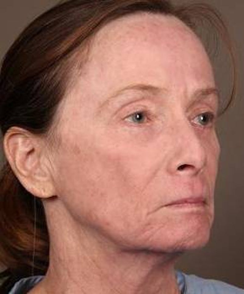 Laser Skin Resurfacing Before & After Gallery - Patient 181898 - Image 4 - Scott Chapin, MD