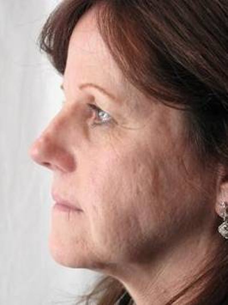 Laser Skin Resurfacing Before & After Gallery - Patient 145226 - Image 1 - Scott Chapin, MD