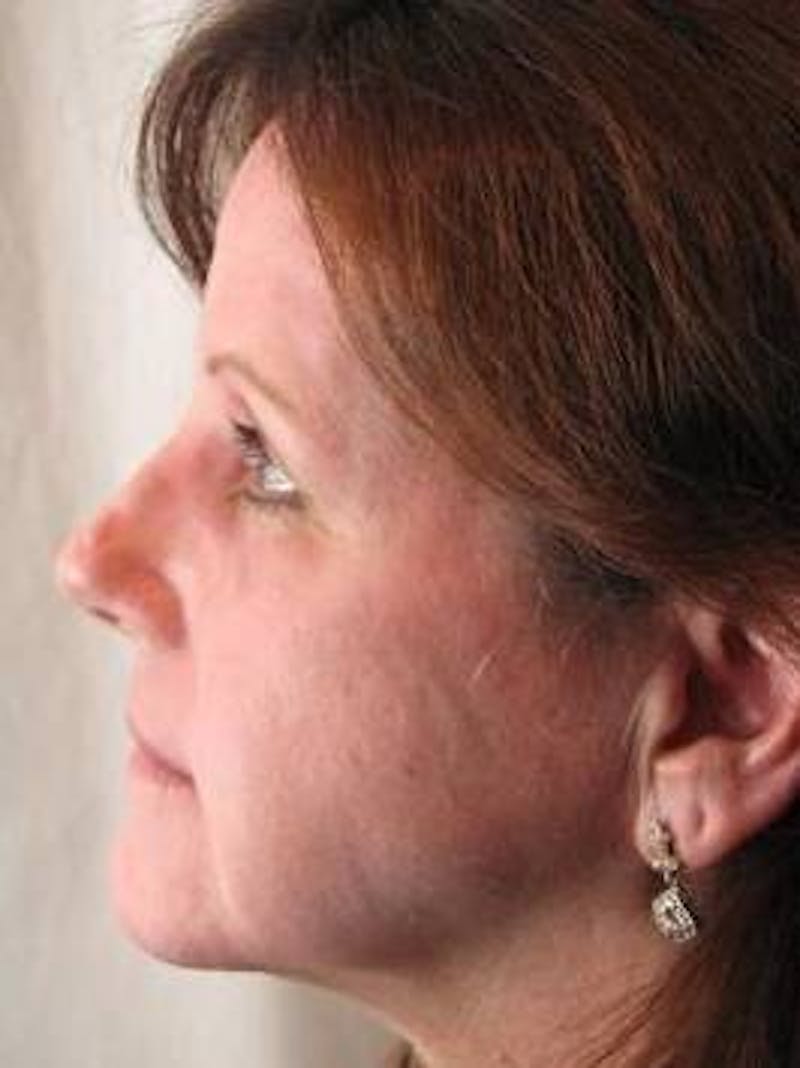 Laser Skin Resurfacing Before & After Gallery - Patient 145226 - Image 2 - Scott Chapin, MD
