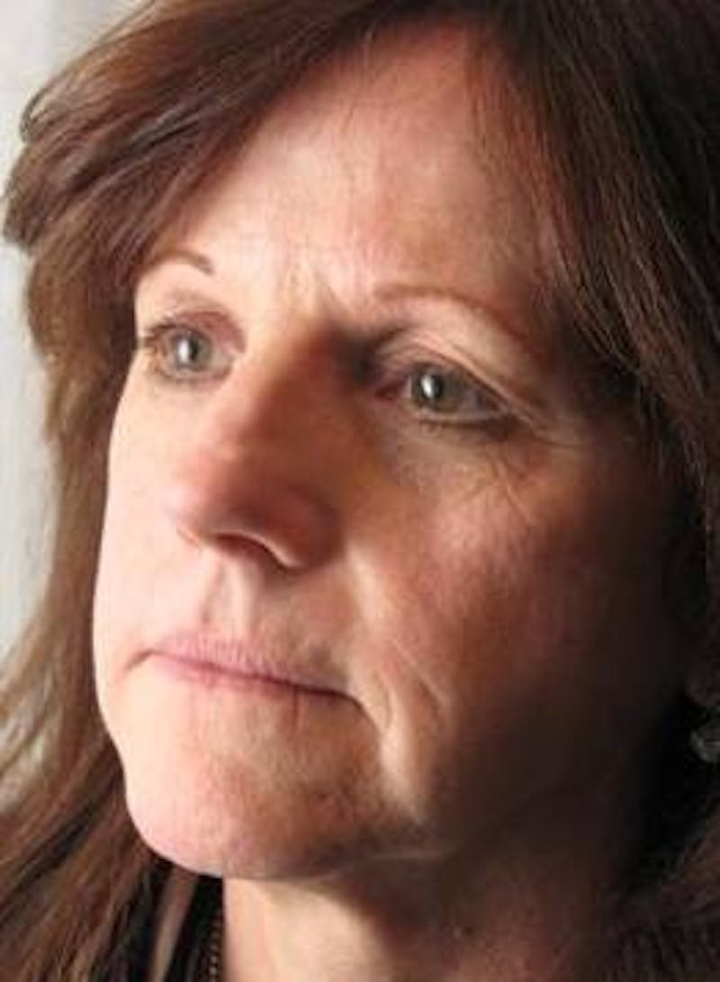 Laser Skin Resurfacing Before & After Gallery - Patient 145226 - Image 3 - Scott Chapin, MD