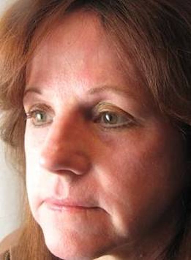 Laser Skin Resurfacing Before & After Gallery - Patient 145226 - Image 4 - Scott Chapin, MD