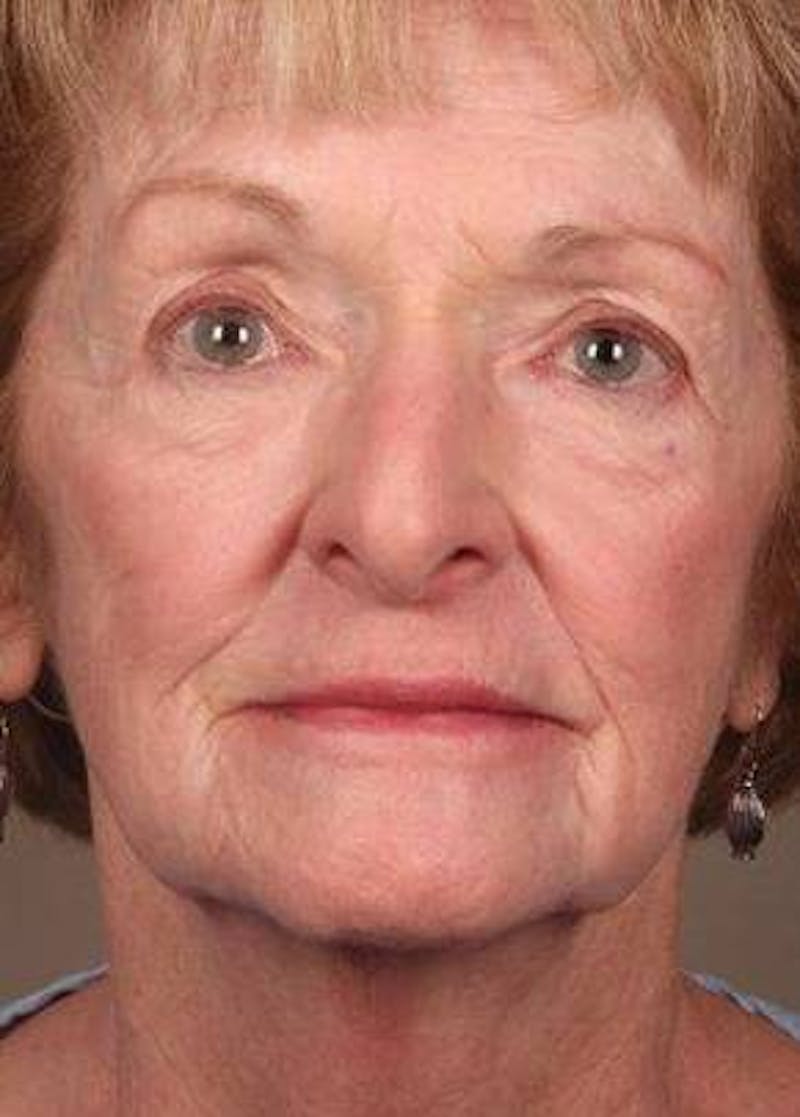 Laser Skin Resurfacing Before & After Gallery - Patient 400383 - Image 1 - Scott Chapin, MD