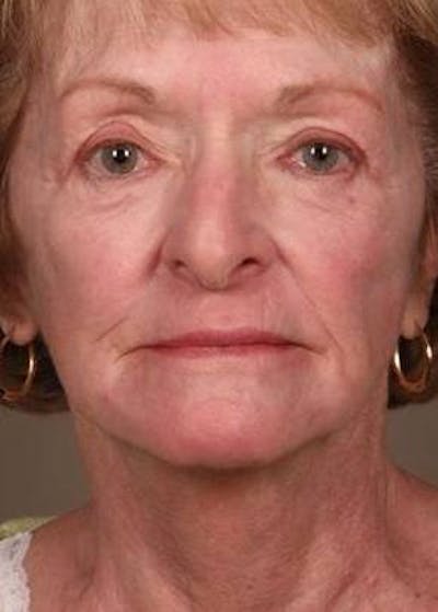 Laser Skin Resurfacing Before & After Gallery - Patient 400383 - Image 2 - Scott Chapin, MD