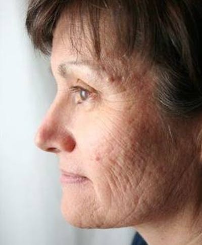 Laser Skin Resurfacing Before & After Gallery - Patient 359912 - Image 1 - Scott Chapin, MD