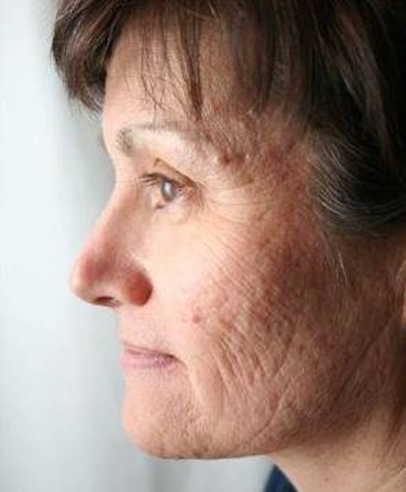 Laser Skin Resurfacing Before & After Gallery - Patient 359912 - Image 1 - Scott Chapin, MD