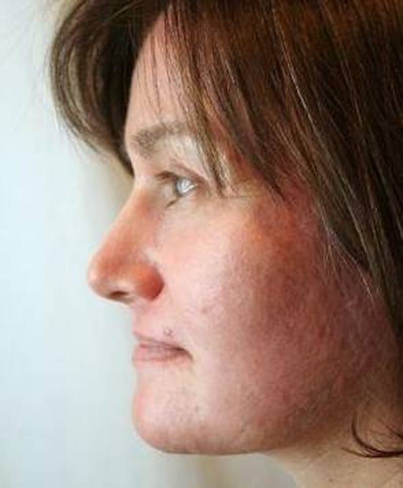 Laser Skin Resurfacing Before & After Gallery - Patient 359912 - Image 2 - Scott Chapin, MD