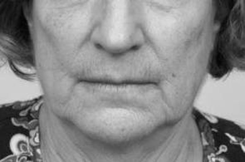 Laser Skin Resurfacing Before & After Gallery - Patient 129747 - Image 1 - Scott Chapin, MD