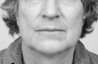 Laser Skin Resurfacing Before & After Gallery - Patient 129747 - Image 2 - Scott Chapin, MD