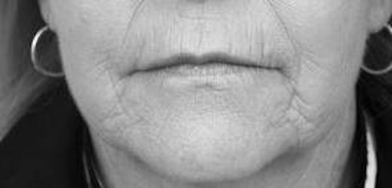 Laser Skin Resurfacing Before & After Gallery - Patient 366053 - Image 1 - Scott Chapin, MD