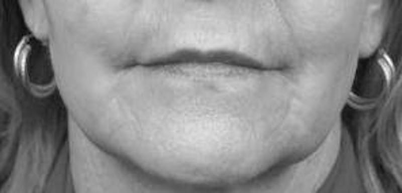 Laser Skin Resurfacing Before & After Gallery - Patient 366053 - Image 2 - Scott Chapin, MD