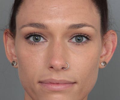 Ear Surgery Before & After Gallery - Patient 804861 - Image 1 - Scott Chapin, MD