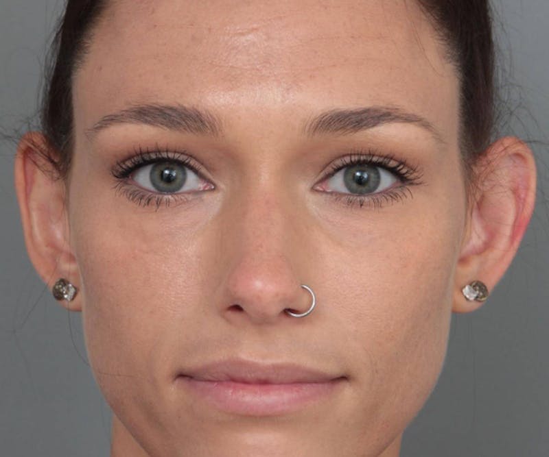 Ear Surgery Before & After Gallery - Patient 804861 - Image 1 - Scott Chapin, MD