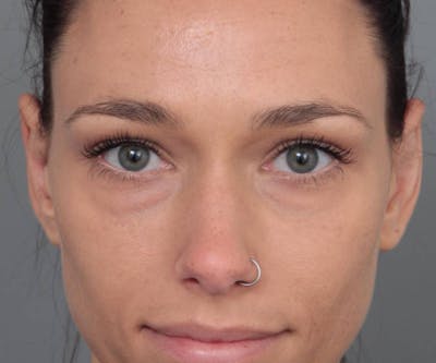 Ear Surgery Before & After Gallery - Patient 804861 - Image 2 - Scott Chapin, MD