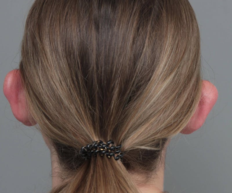 Ear Surgery Before & After Gallery - Patient 183139 - Image 3 - Scott Chapin, MD