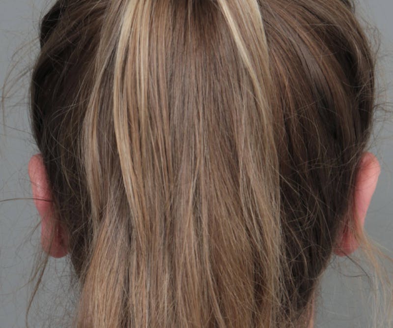 Ear Surgery Before & After Gallery - Patient 183139 - Image 4 - Scott Chapin, MD