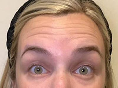 Botox Before & After Gallery - Patient 403258 - Image 1 - Scott Chapin, MD