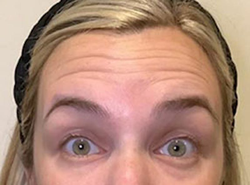 Botox Before & After Gallery - Patient 403258 - Image 1 - Scott Chapin, MD