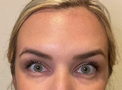 Botox Before & After Gallery - Patient 403258 - Image 2 - Scott Chapin, MD