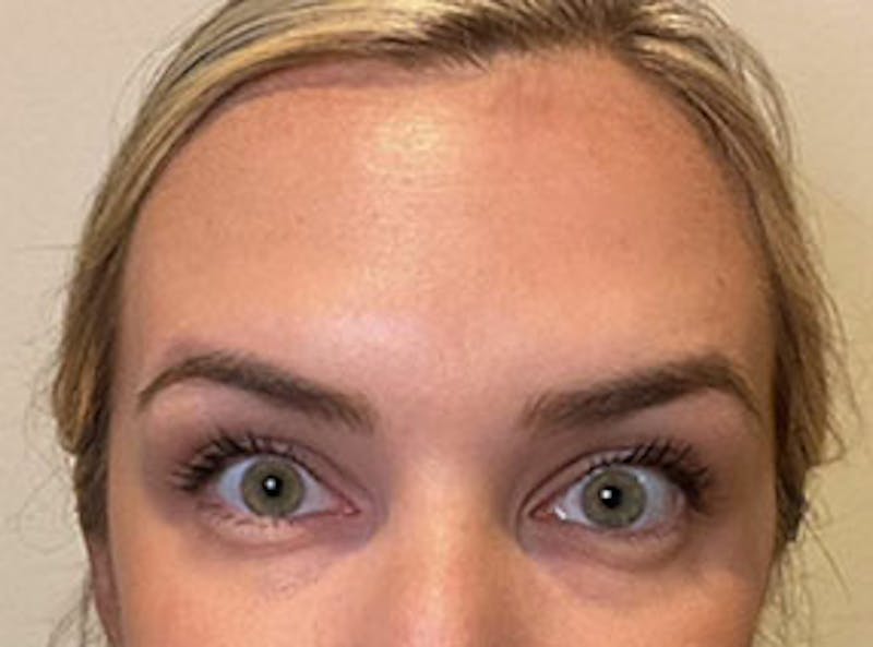 Botox Before & After Gallery - Patient 403258 - Image 2 - Scott Chapin, MD