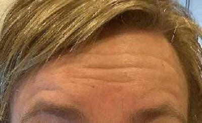 Botox Before & After Gallery - Patient 287741 - Image 1 - Scott Chapin, MD